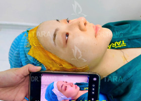 Nâng mũi không nẹp là gì? Khác gì với nâng mũi thông thường?