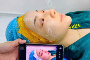 Nâng mũi không nẹp là gì? Khác gì với nâng mũi thông thường?