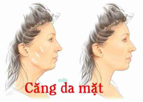 Phẫu thuật căng da nâng cơ là gì? Khác gì so với căng da thông thường?