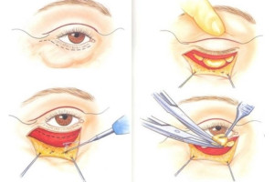 Xoá rãnh lệ hiệu quả từ phẫu thuật dàn đều mỡ dưới mắt