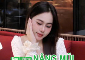 Ai nên nâng mũi không nẹp? 5 nhóm khách phù hợp nhất