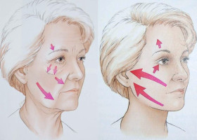 Căng da nâng cơ giữ được bao lâu? Làm sao để hiệu quả lâu dài hơn?