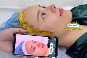 Nâng mũi đẹp tại TP.HCM giá bao nhiêu? Tham khảo bảng giá & lộ trình tại TARA Beauty