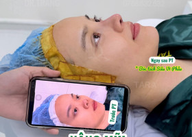 14 câu hỏi thường gặp về nâng mũi không nẹp (giải đáp bởi TS.BS Trang TARA)