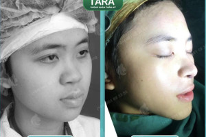 Nâng mũi không nẹp có an toàn không? 7 yếu tố quyết định độ an toàn