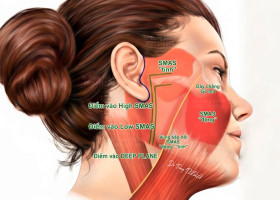 Căng da Midface xử lý rãnh mũi má và má chảy xệ như thế nào?