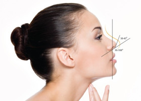 Nên căng da midface trước hay nâng mũi trước? Bác sĩ giải thích theo từng trường hợp