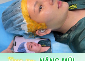 Sau nâng mũi không nẹp bao lâu thì hết sưng, bao lâu thì đẹp tự nhiên?