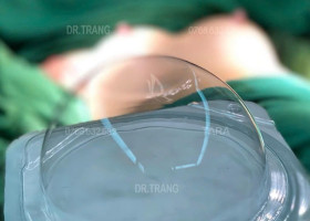 Nâng ngực đẹp cho mẹ sau sinh: xử lý ngực chảy xệ, teo nhỏ như thế nào?