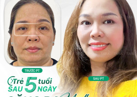 Ai nên làm combo căng da midface và nâng mũi? 5 dấu hiệu gương mặt ‘xuống sắc’ cần can thiệp