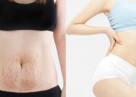 Sau sinh bao lâu thì có thể làm Mommy makeover? Mẹ còn cho con bú có làm được không?