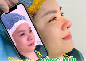 Nâng mũi không nẹp có an toàn không? Những rủi ro cần biết & cách hạn chế