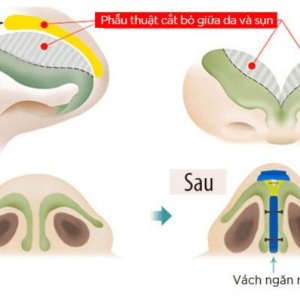 Giải đáp từ A-Z về nâng mũi bán cấu trúc dựng trụ  