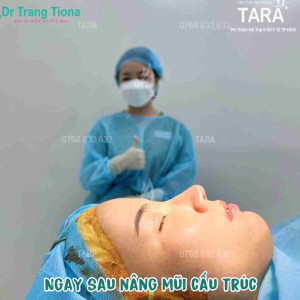 Hình ảnh nâng mũi cấu trúc sau 14 ngày trông như thế nào?