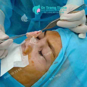 Trung bì mỡ là gì? Có vai trò như nào trong nâng mũi?