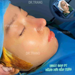 3 lưu ý quan trọng khi nâng mũi sau 10 ngày