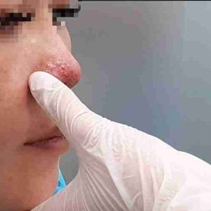 Lộ sụn đầu mũi và dấu hiệu nhận biết để kịp chữa trị