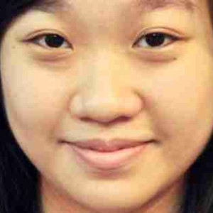 Bác sĩ giải đáp: Làm sao để khắc phục mũi củ hành?