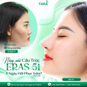 Nâng mũi hồi phục sớm 5i