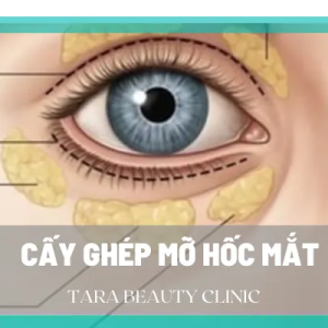Toàn bộ thông tin về cấy mỡ tự thân hốc mắt trẻ hóa mắt