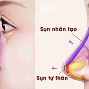 Nâng mũi cấu trúc, liệu có phải là trào lưu nhất thời?