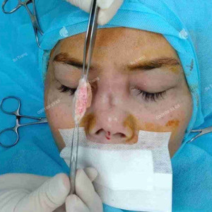 Mỡ trung bì là gì? Tại sao được dùng để nâng mũi?