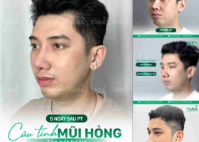 Nâng mũi xong có đi máy bay được không? – Nâng mũi ERAS 5i