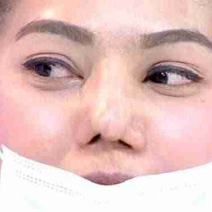 Nâng mũi bằng sụn tai thường bị những biến chứng nào?