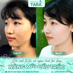 Bác sĩ giải đáp: Nâng mũi sau một tháng đã lành và đẹp chưa?