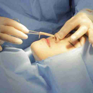 Nâng mũi xong tháo sụn ra có ảnh hưởng gì không?