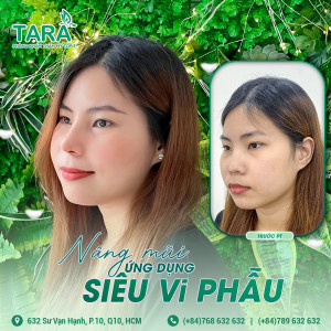 Review nâng mũi không đau tại TARA Beauty Clinic