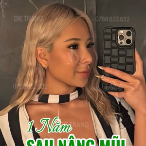 Vừa nâng mũi siêu vi phẫu vừa cấy mỡ mặt, có được không?