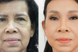 Bác sĩ phẫu thuật căng da mặt nội soi giỏi tại TPHCM