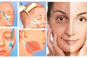 So sánh căng da mặt nội soi-căng da mặt truyền thống