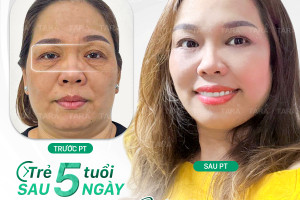Khắc phục da chảy xệ vùng mặt nhờ căng da Midface