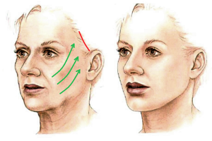 Kỹ thuật căng da mặt nội soi: Phép màu trẻ hóa an toàn