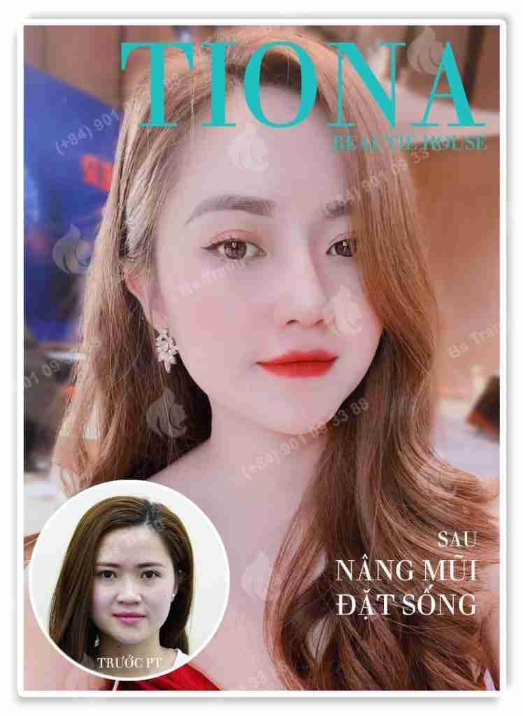 Nâng sống mũi Bác sĩ Trang