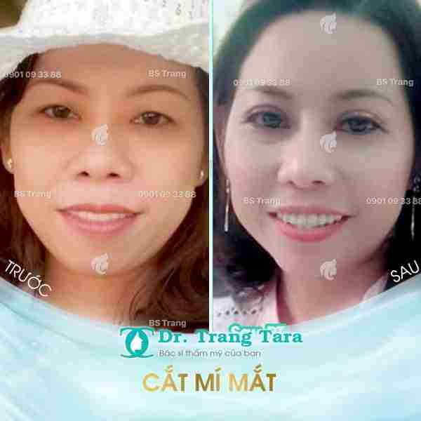 Cắt mí mắt Những Lưu Ý Quan Trọng