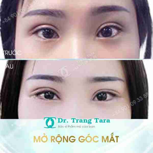 Mở Rộng Góc Mắt