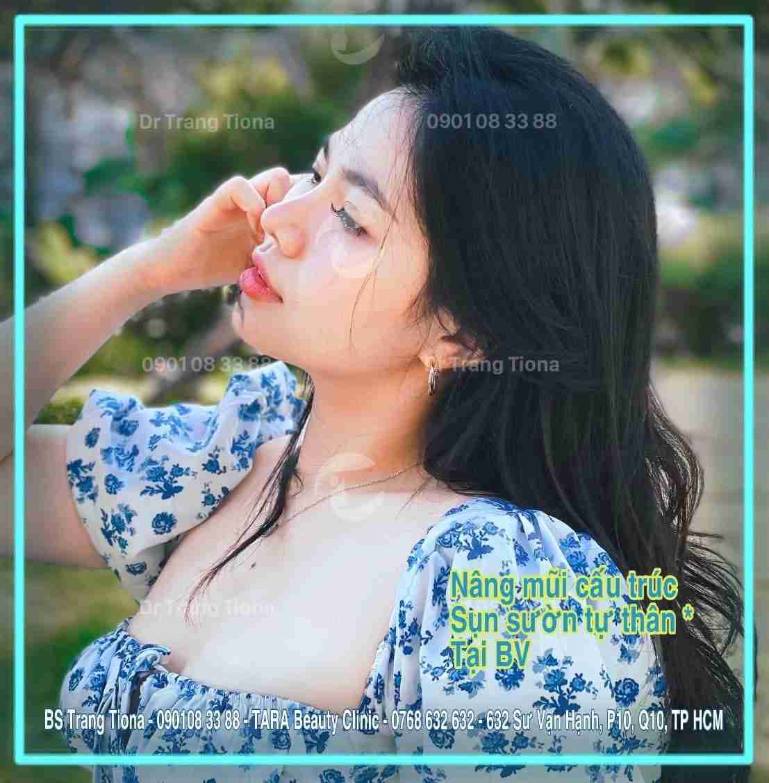 nâng mũi sụn sườn bác sĩ Trang
