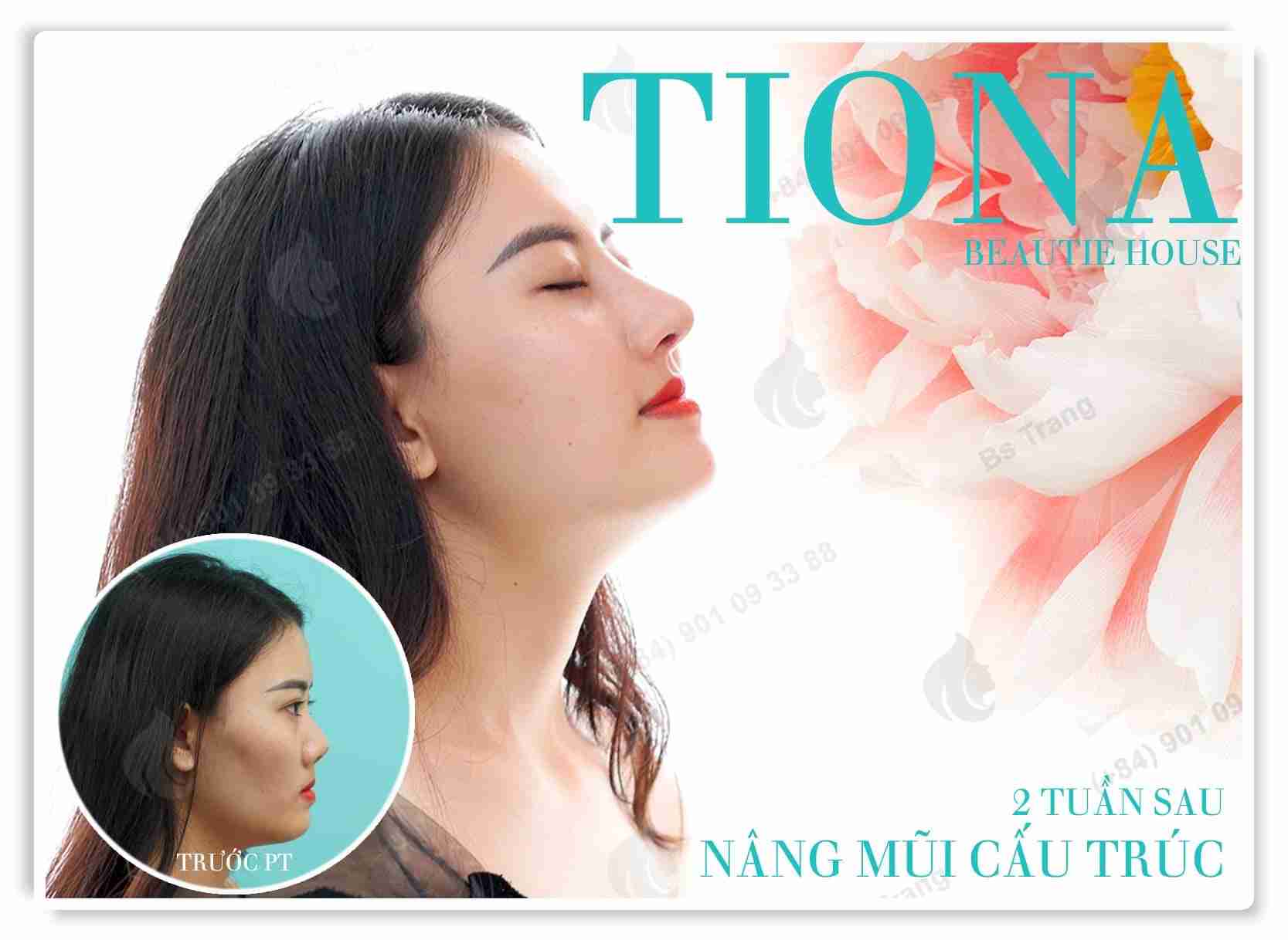 Tại sao mũi lệch vẹo và đâu là cách khắc phục mũi lệch vẹo hiệu quả?