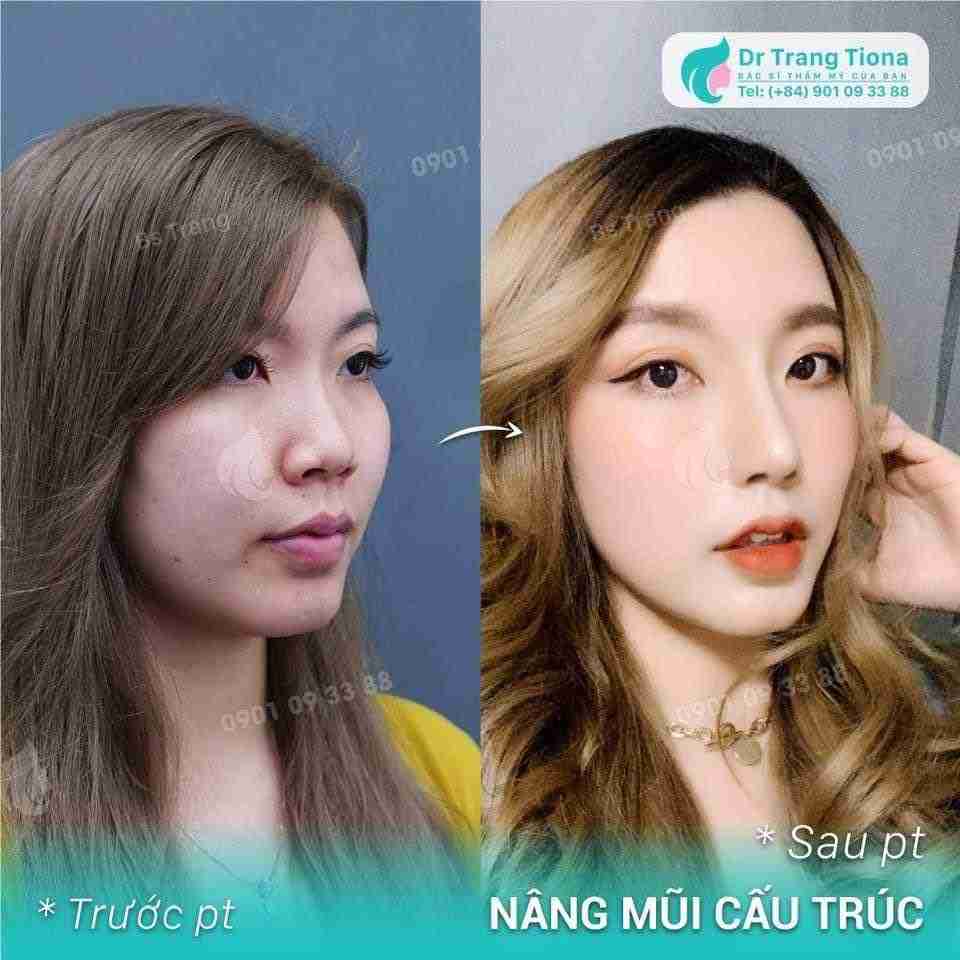 giảm sưng sau nâng mũi