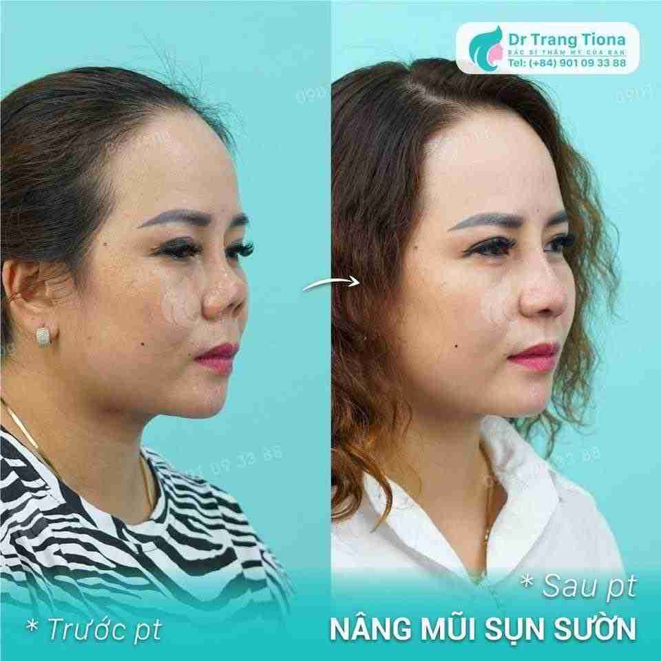 Đầu mũi bị đỏ sau nâng mũi