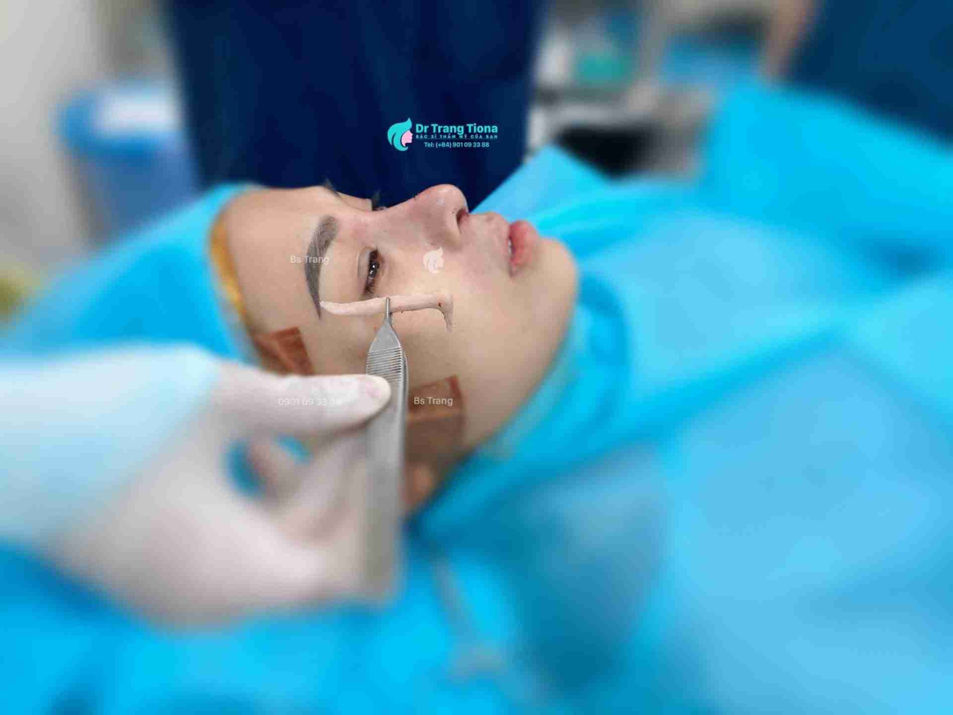 Nâng mũi cấu trúc có thật sự an toàn?