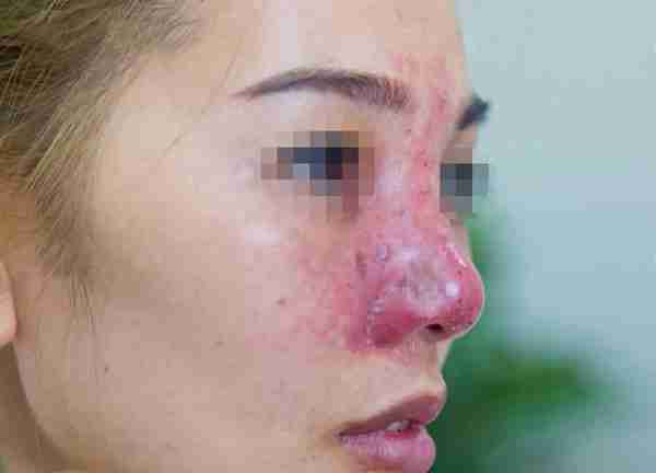 Dấu hiệu bị nhiễm trùng mũi