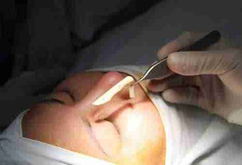Tháo sụn mũi xong mũi có trở lại bình thường không?