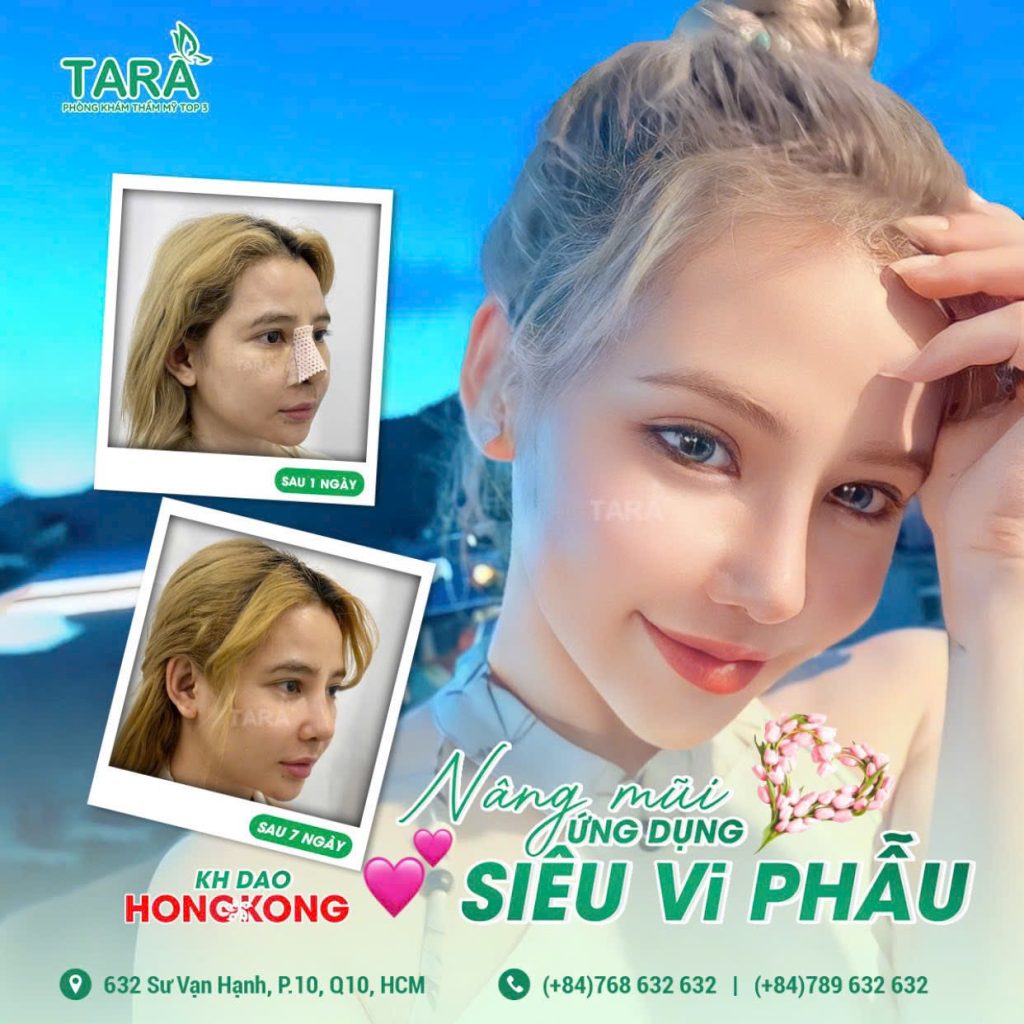 Review nâng mũi Bác sĩ Trang khách hàng từ Hongkong