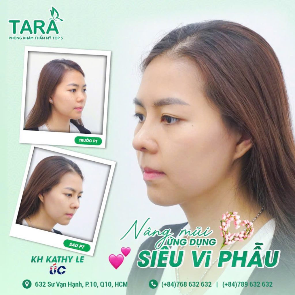 Review nâng mũi Bác sĩ Trang khách hàng từ Úc