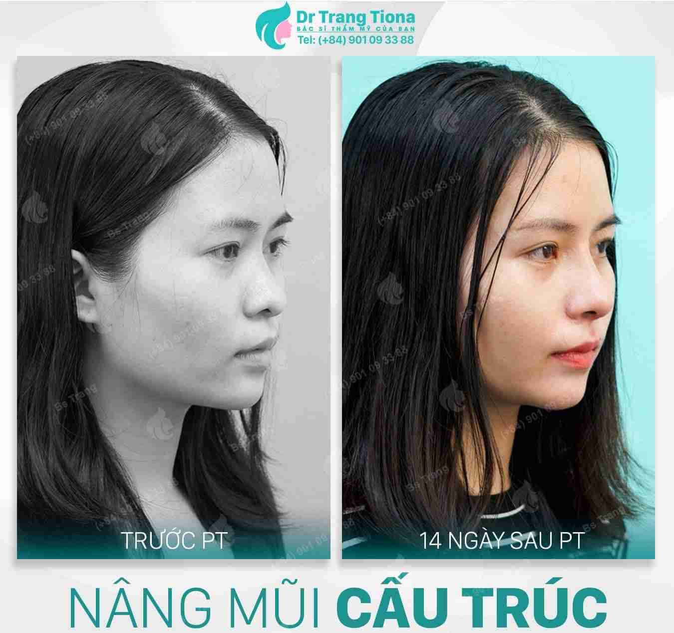 Nâng mũi sau bao lâu thì đi làm được