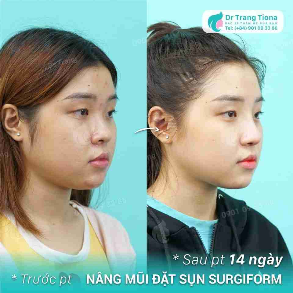 Sửa mũi gãy bằng phương pháp nào? Giá bao nhiêu?